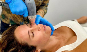 The Need to Know on Radiofrequency Microneedling